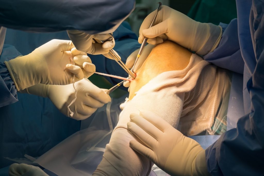 ACL treatment