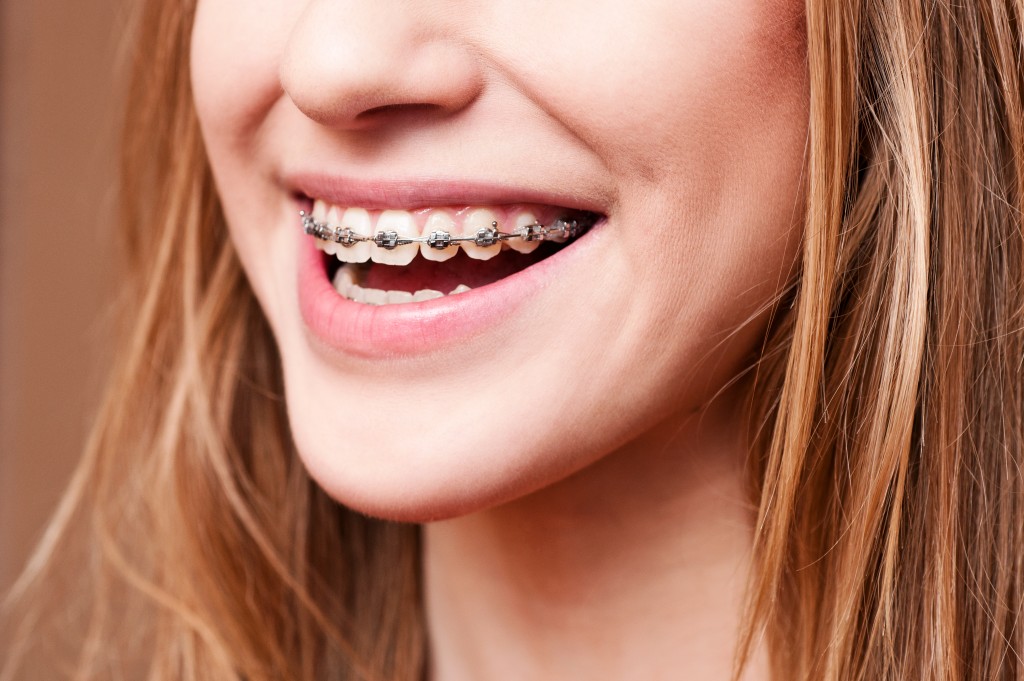braces teeth wear stay taking