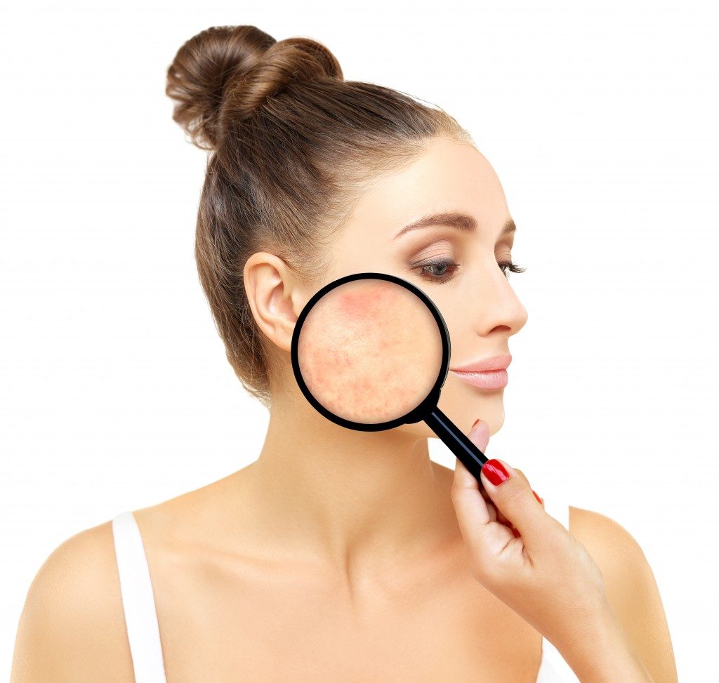 woman with acne scars