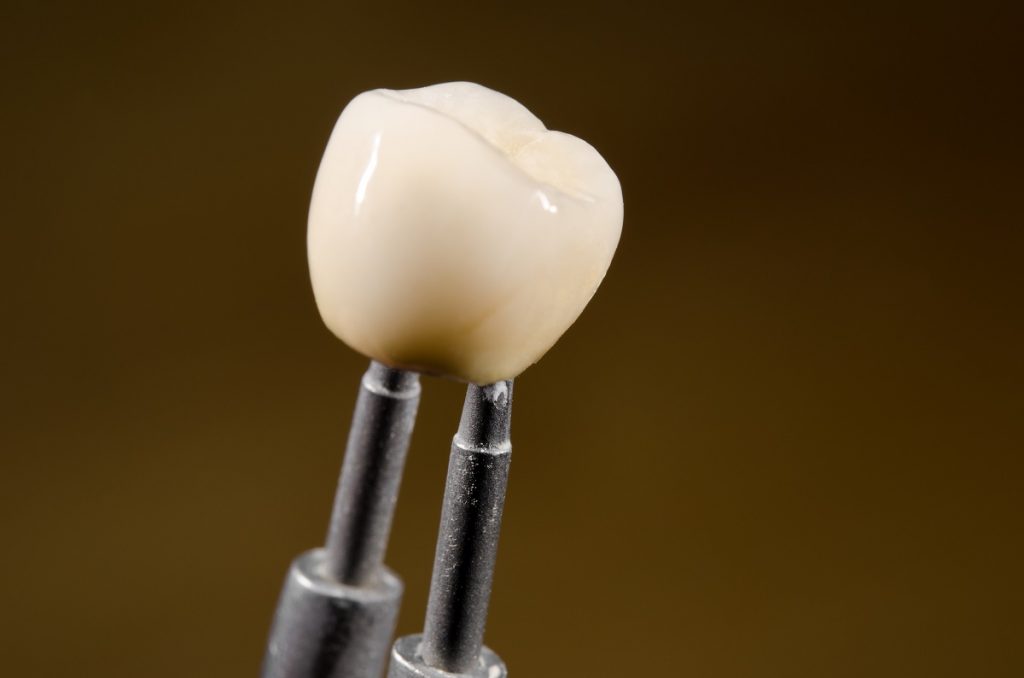 dental implant