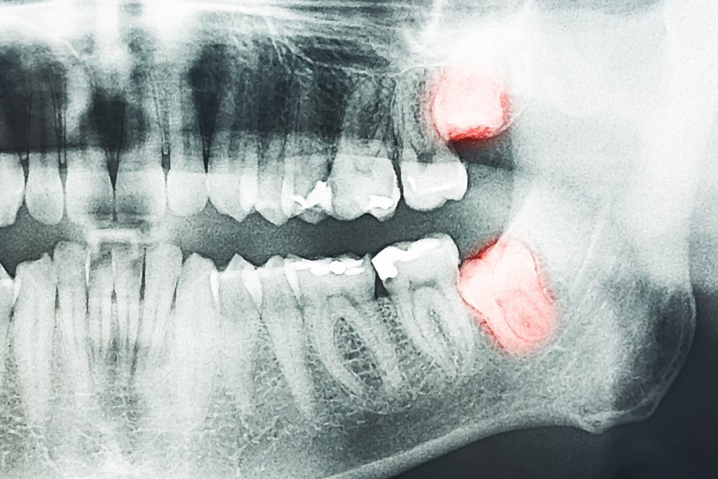 x-ray of wisdom tooth