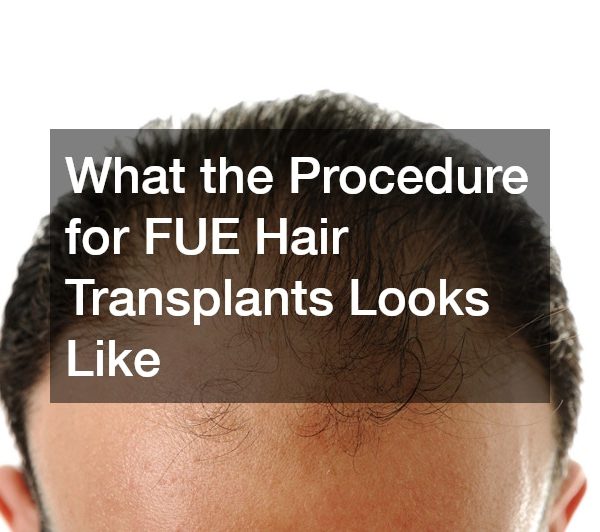 What the Procedure for FUE Hair Transplants Looks Like